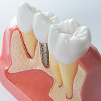 Jaw and Gum Resorption Specialist Near Me in Dallas TX