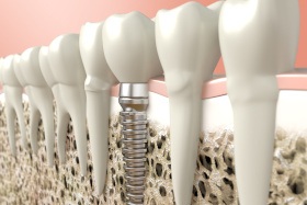 Illustration of dental implant in Dallas, TX in jawbone