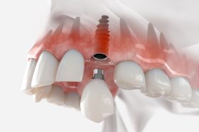 Render of crown being attached to dental implant in Dallas, TX