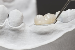 Dental crown on model of teeth