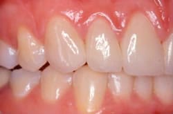 After treatment: front teeth restored with veneers and porcelain crowns