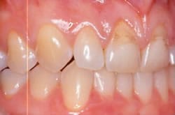 Before treatment: worn, uneven front teeth