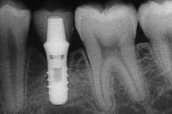 X-ray of the dental implant with the crown attached